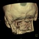 Spina bifida, atlas: CT - Computed tomography